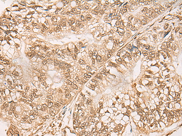 Immunohistochemistry of paraffin-embedded Human gastric cancer tissue using WEE1 Polyclonal Antibody at dilution of 1:35(×200)