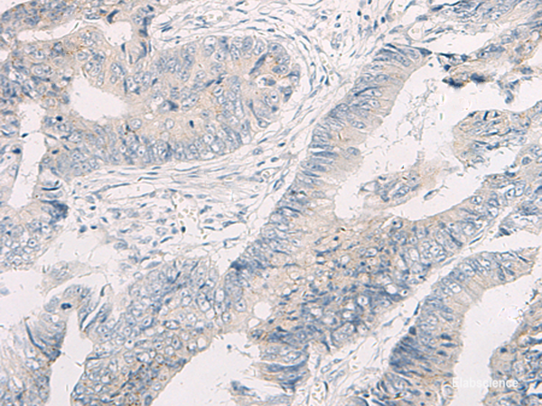 Immunohistochemistry of paraffin-embedded Human colorectal cancer tissue using WNK4 Polyclonal Antibody at dilution of 1:45(×200)