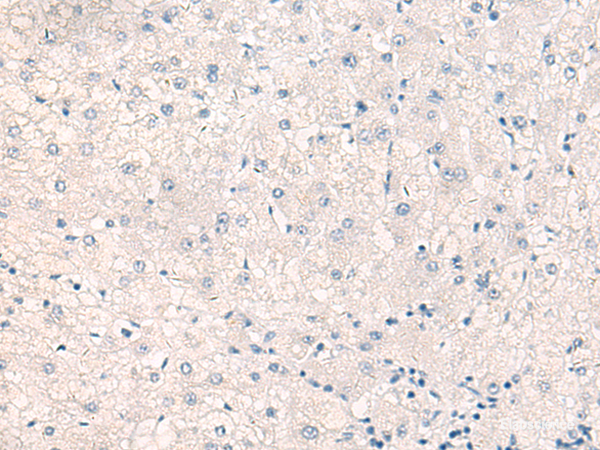 Immunohistochemistry of paraffin-embedded Human liver cancer tissue using CEBPB Polyclonal Antibody at dilution of 1:30(×200)