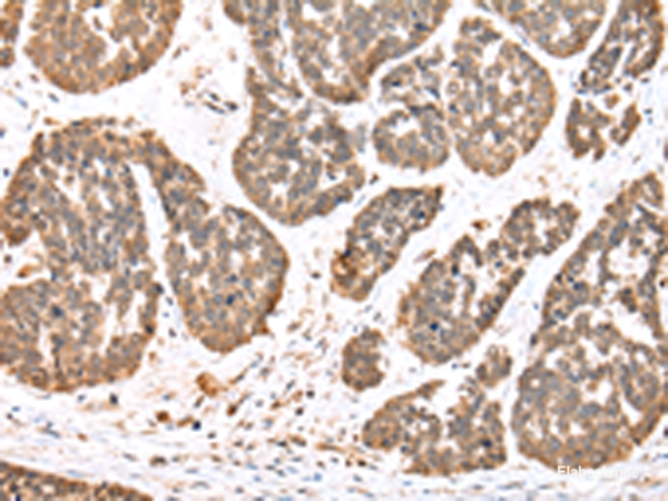 Immunohistochemistry of paraffin-embedded Human esophagus cancer tissue using DDX58 Polyclonal Antibody at dilution of 1:35(×200)