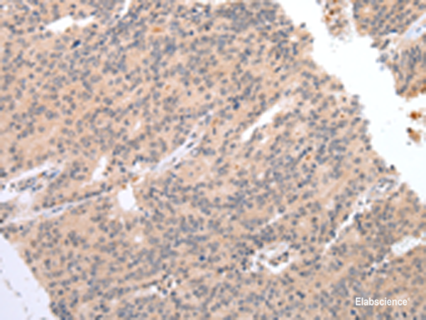 Immunohistochemistry of paraffin-embedded Human prost at e cancer tissue using DEFB112 Polyclonal Antibody at dilution of 1:40(×200)