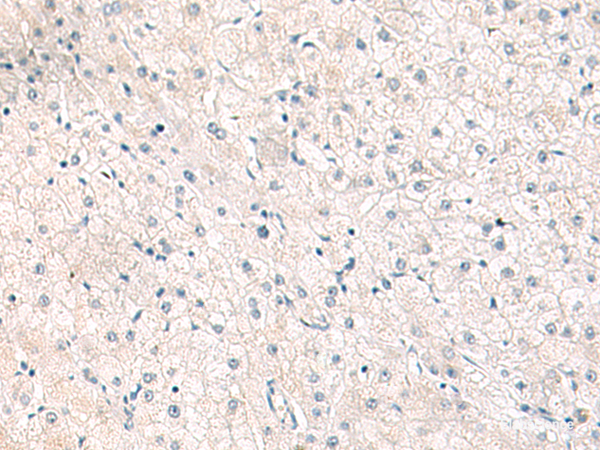Immunohistochemistry of paraffin-embedded Human liver cancer tissue using FGFR4 Polyclonal Antibody at dilution of 1:25(×200)