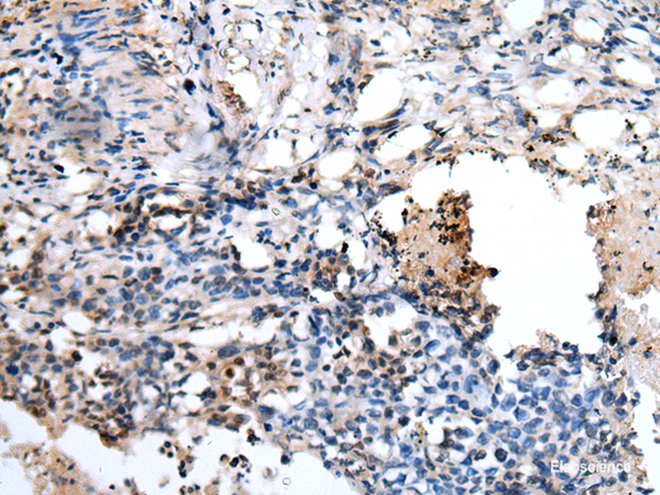 Immunohistochemistry of paraffin-embedded Human lung cancer tissue using PPP1R15A Polyclonal Antibody at dilution of 1:45(×200)