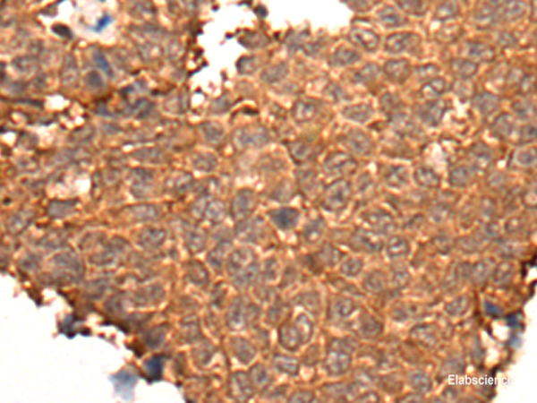 Immunohistochemistry of paraffin-embedded Human ovarian cancer tissue using HOXD8 Polyclonal Antibody at dilution of 1:40(×200)