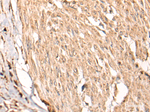 Immunohistochemistry of paraffin-embedded Human cervical cancer tissue using HSF4 Polyclonal Antibody at dilution of 1:55(×200)
