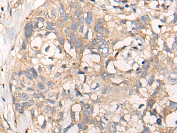 Immunohistochemistry of paraffin-embedded Human lung cancer tissue using NREP Polyclonal Antibody at dilution of 1:35(×200)