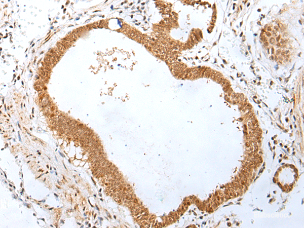 Immunohistochemistry of paraffin-embedded Human gastric cancer tissue using PEG3 Polyclonal Antibody at dilution of 1:45(×200)