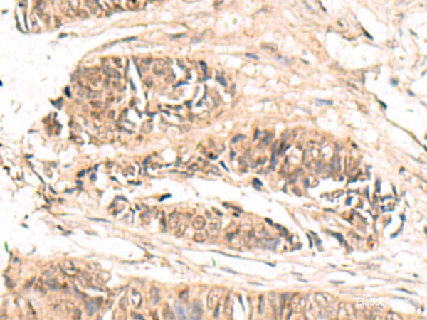 Immunohistochemistry of paraffin-embedded Human colorectal cancer tissue using ABCB4 Polyclonal Antibody at dilution of 1:70(×200)