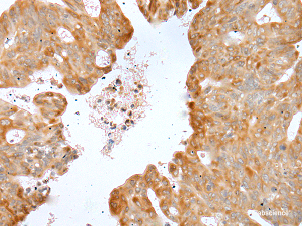 Immunohistochemistry of paraffin-embedded Human gastric cancer tissue using P2RY4 Polyclonal Antibody at dilution of 1:40(×200)