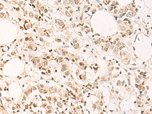Immunohistochemistry of paraffin-embedded Human breast cancer tissue using DPPA4 Polyclonal Antibody at dilution of 1:55(×200)