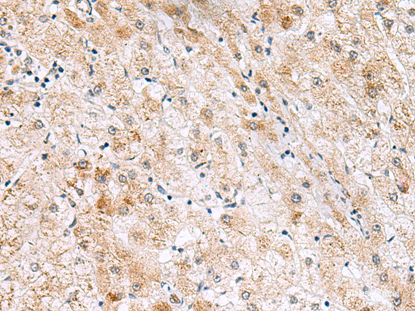Immunohistochemistry of paraffin-embedded Human liver cancer tissue using GPC2 Polyclonal Antibody at dilution of 1:40(×200)