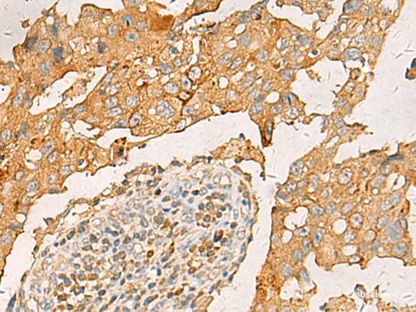 Immunohistochemistry of paraffin-embedded Human breast cancer tissue using CXCL1 Polyclonal Antibody at dilution of 1:35(×200)