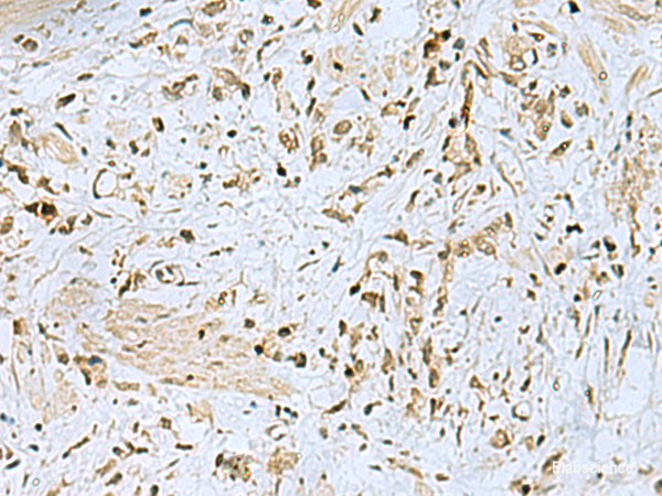 Immunohistochemistry of paraffin-embedded Human gastric cancer tissue using HOXC9 Polyclonal Antibody at dilution of 1:40(×200)