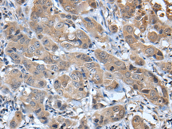 Immunohistochemistry of paraffin-embedded Human breast cancer tissue using CXCL5 Polyclonal Antibody at dilution of 1:45(×200)