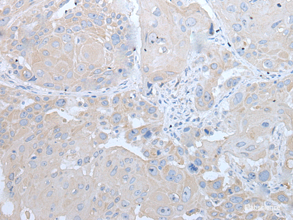 Immunohistochemistry of paraffin-embedded Human esophagus cancer tissue using IFNB1 Polyclonal Antibody at dilution of 1:45(×200)