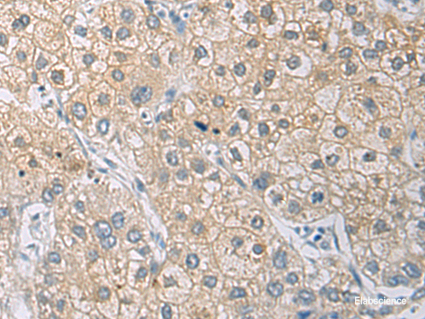 Immunohistochemistry of paraffin-embedded Human liver cancer tissue using IL1RN Polyclonal Antibody at dilution of 1:50(×200)