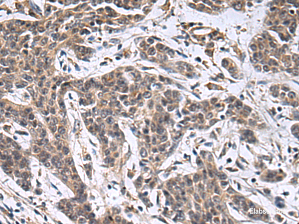 Immunohistochemistry of paraffin-embedded Human colorectal cancer tissue using MBL2 Polyclonal Antibody at dilution of 1:25(×200)