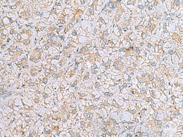 Immunohistochemistry of paraffin-embedded Human liver cancer tissue using LRRC49 Polyclonal Antibody at dilution of 1:40(×200)