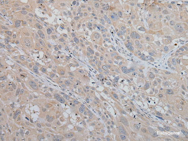 Immunohistochemistry of paraffin-embedded Human esophagus cancer tissue using MLANA Polyclonal Antibody at dilution of 1:50(×200)