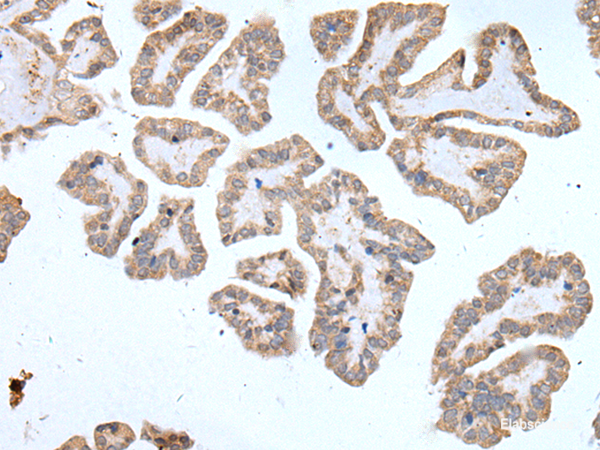 Immunohistochemistry of paraffin-embedded Human thyroid cancer tissue using ABCD1 Polyclonal Antibody at dilution of 1:80(×200)
