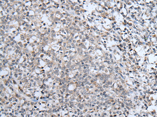 Immunohistochemistry of paraffin-embedded Human tonsil tissue using ABCA6 Polyclonal Antibody at dilution of 1:40(×200)