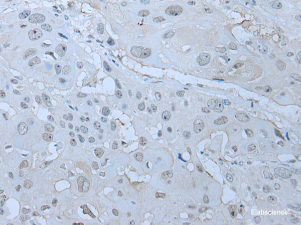 Immunohistochemistry of paraffin-embedded Human esophagus cancer tissue using HUWE1 Polyclonal Antibody at dilution of 1:30(×200)