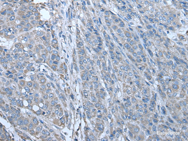 Immunohistochemistry of paraffin-embedded Human liver cancer tissue using ZC3HAV1 Polyclonal Antibody at dilution of 1:70(×200)