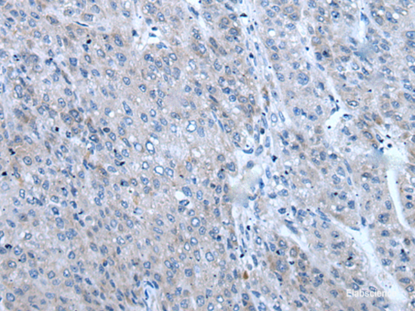 Immunohistochemistry of paraffin-embedded Human liver cancer tissue using ZIC1 Polyclonal Antibody at dilution of 1:65(×200)