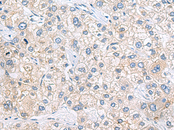 Immunohistochemistry of paraffin-embedded Human liver cancer tissue using ZNF35 Polyclonal Antibody at dilution of 1:40(×200)