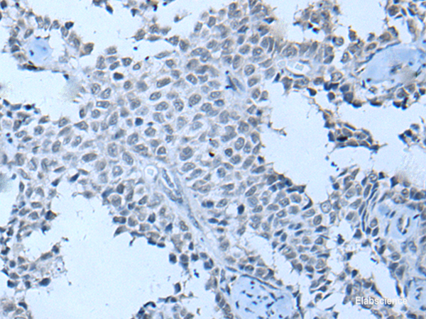 Immunohistochemistry of paraffin-embedded Human ovarian cancer tissue using ZNF703 Polyclonal Antibody at dilution of 1:55(×200)