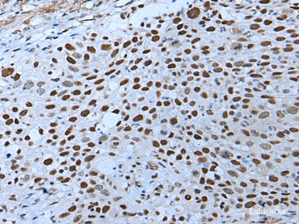 Immunohistochemistry of paraffin-embedded Human lung cancer tissue using ZNHIT3 Polyclonal Antibody at dilution of 1:80(×200)