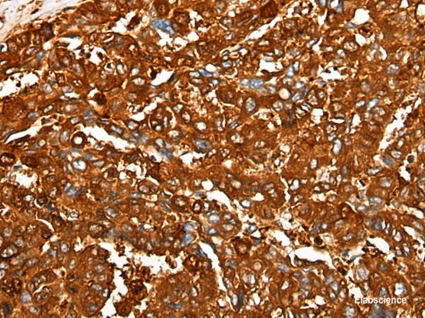 Immunohistochemistry of paraffin-embedded Human liver cancer tissue using PEAR1 Polyclonal Antibody at dilution of 1:25(×200)