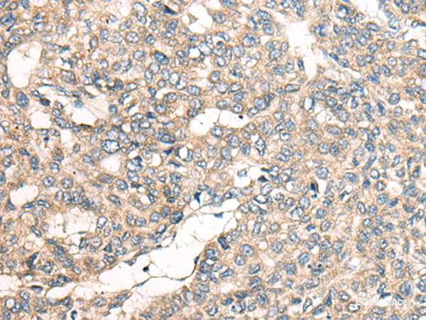 Immunohistochemistry of paraffin-embedded Human liver cancer tissue using LRP1B Polyclonal Antibody at dilution of 1:50(×200)