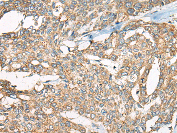 Immunohistochemistry of paraffin-embedded Human liver cancer tissue using YEATS2 Polyclonal Antibody at dilution of 1:55(×200)
