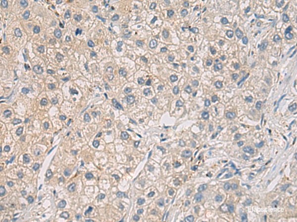 Immunohistochemistry of paraffin-embedded Human liver cancer tissue using WFDC3 Polyclonal Antibody at dilution of 1:40(×200)