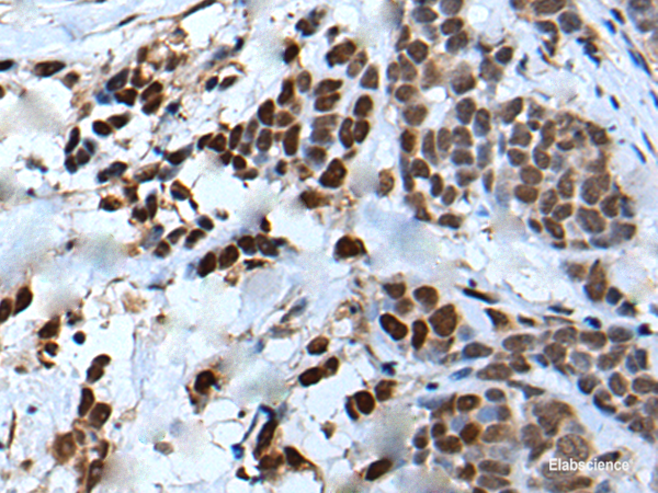 Immunohistochemistry of paraffin-embedded Human thyroid cancer tissue using VEZT Polyclonal Antibody at dilution of 1:50(×200)