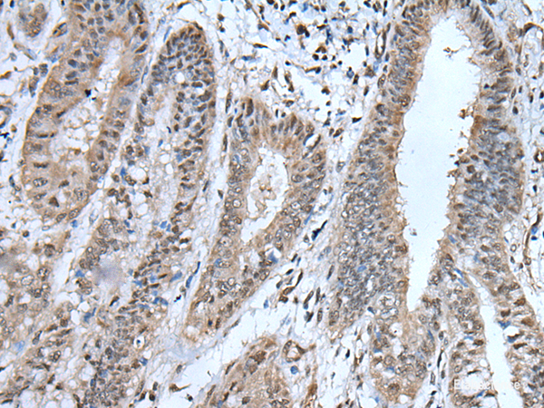 Immunohistochemistry of paraffin-embedded Human liver cancer tissue using UBA52 Polyclonal Antibody at dilution of 1:55(×200)