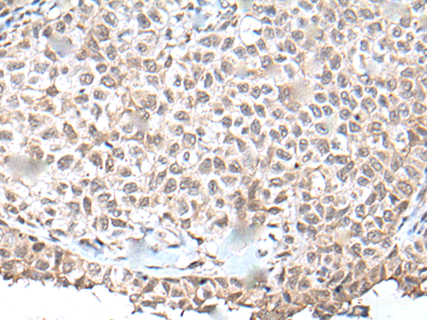 Immunohistochemistry of paraffin-embedded Human ovarian cancer tissue using UBN1 Polyclonal Antibody at dilution of 1:130(×200)