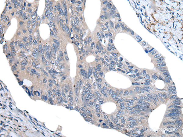 Immunohistochemistry of paraffin-embedded Human colorectal cancer tissue using UBR4 Polyclonal Antibody at dilution of 1:55(×200)