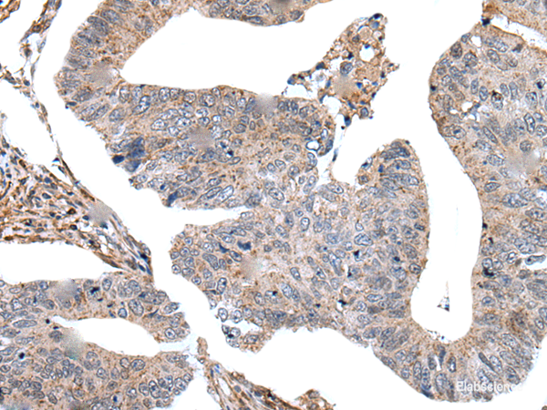 Immunohistochemistry of paraffin-embedded Human colorectal cancer tissue using USP37 Polyclonal Antibody at dilution of 1:45(×200)