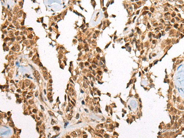 Immunohistochemistry of paraffin-embedded Human ovarian cancer tissue using ATE1 Polyclonal Antibody at dilution of 1:60(×200)