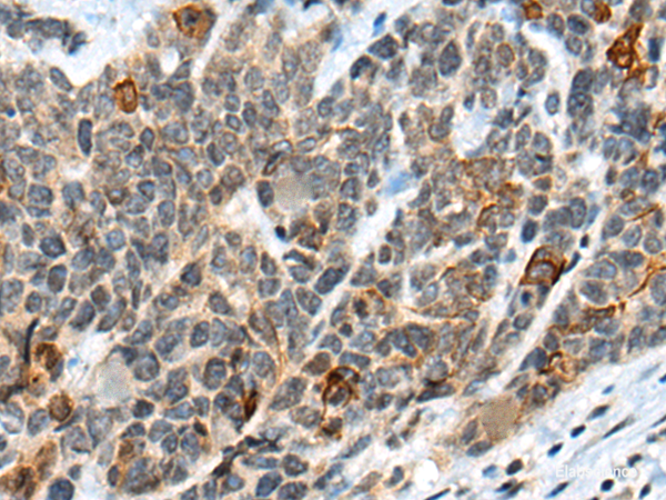 Immunohistochemistry of paraffin-embedded Human thyroid cancer tissue using ATRX Polyclonal Antibody at dilution of 1:50(×200)