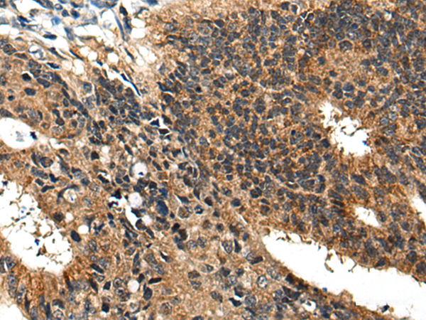 Immunohistochemistry of paraffin-embedded Human colorectal cancer tissue using BMPER Polyclonal Antibody at dilution of 1:40(×200)