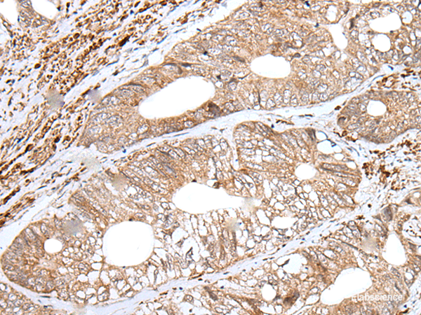 Immunohistochemistry of paraffin-embedded Human colorectal cancer tissue using ENPEP Polyclonal Antibody at dilution of 1:65(×200)