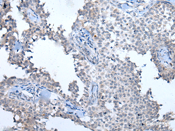 Immunohistochemistry of paraffin-embedded Human ovarian cancer tissue using ATM Polyclonal Antibody at dilution of 1:65(×200)