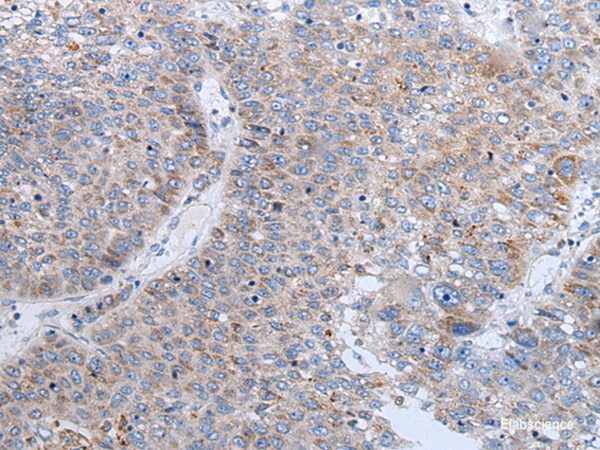 Immunohistochemistry of paraffin-embedded Human liver cancer tissue using ENPP2 Polyclonal Antibody at dilution of 1:50(×200)
