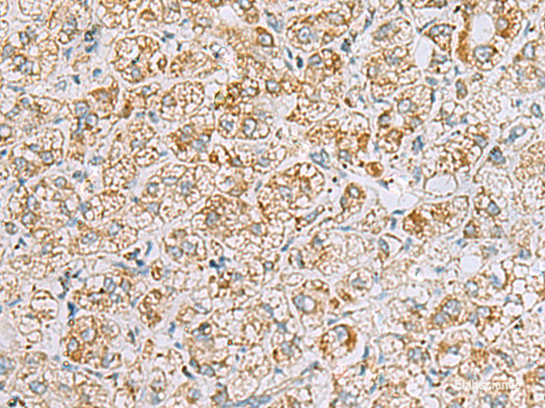 Immunohistochemistry of paraffin-embedded Human liver cancer tissue using INS(C-peptide) Polyclonal Antibody at dilution of 1:40(×200)