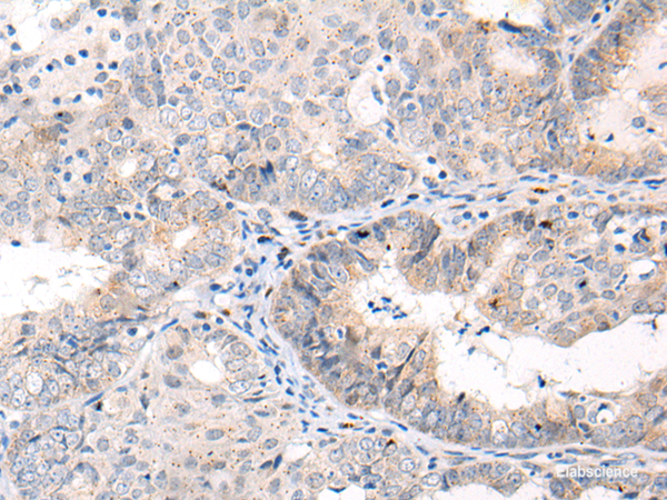 Immunohistochemistry of paraffin-embedded Human ovarian cancer tissue using ANAPC15 Polyclonal Antibody at dilution of 1:70(×200)