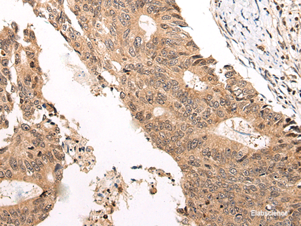 Immunohistochemistry of paraffin-embedded Human colorectal cancer tissue using CHAMP1 Polyclonal Antibody at dilution of 1:40(×200)