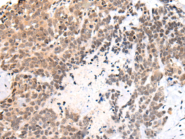 Immunohistochemistry of paraffin-embedded Human thyroid cancer tissue using C14orf169 Polyclonal Antibody at dilution of 1:45(×200)